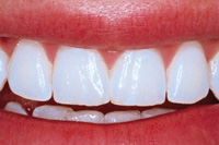 whitening after