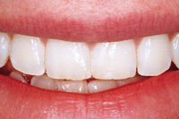 whitening before